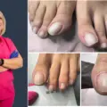 O unghie tăiată greșit poate părea un detaliu… până când devine durere la fiecare pas